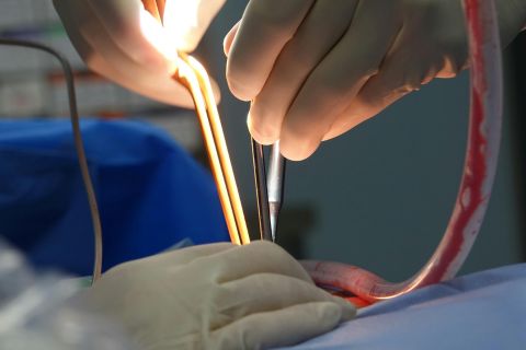 Laparoscopy