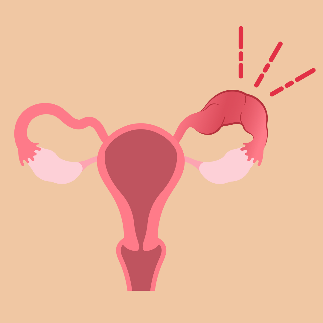 ectopic-pregnancy-kalpa-clinic Ectopic Pregnancy